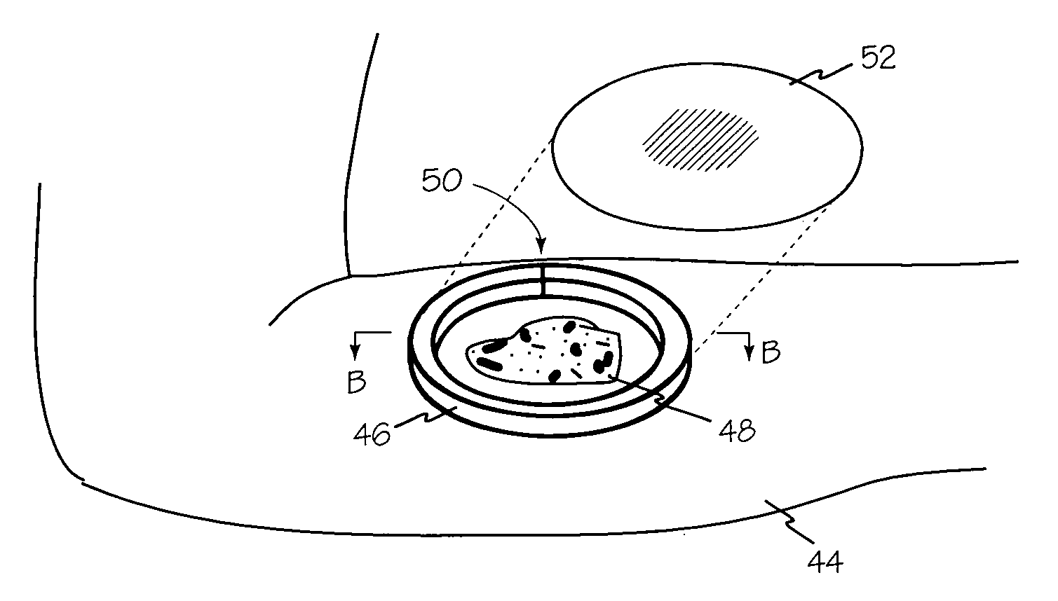 Dressing substrate