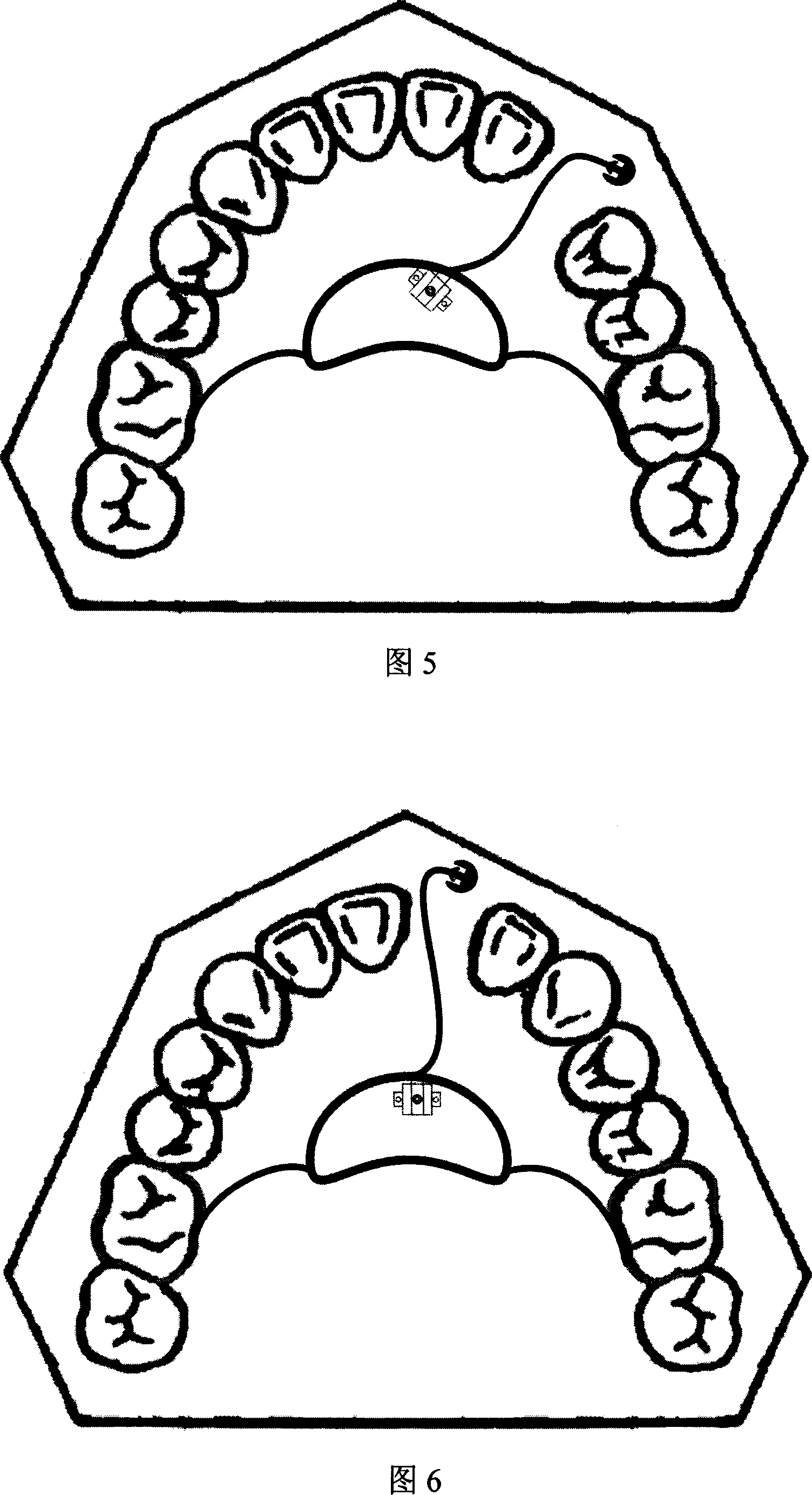 Upper jaw embedded impacted tooth quide rod type correcting appliance