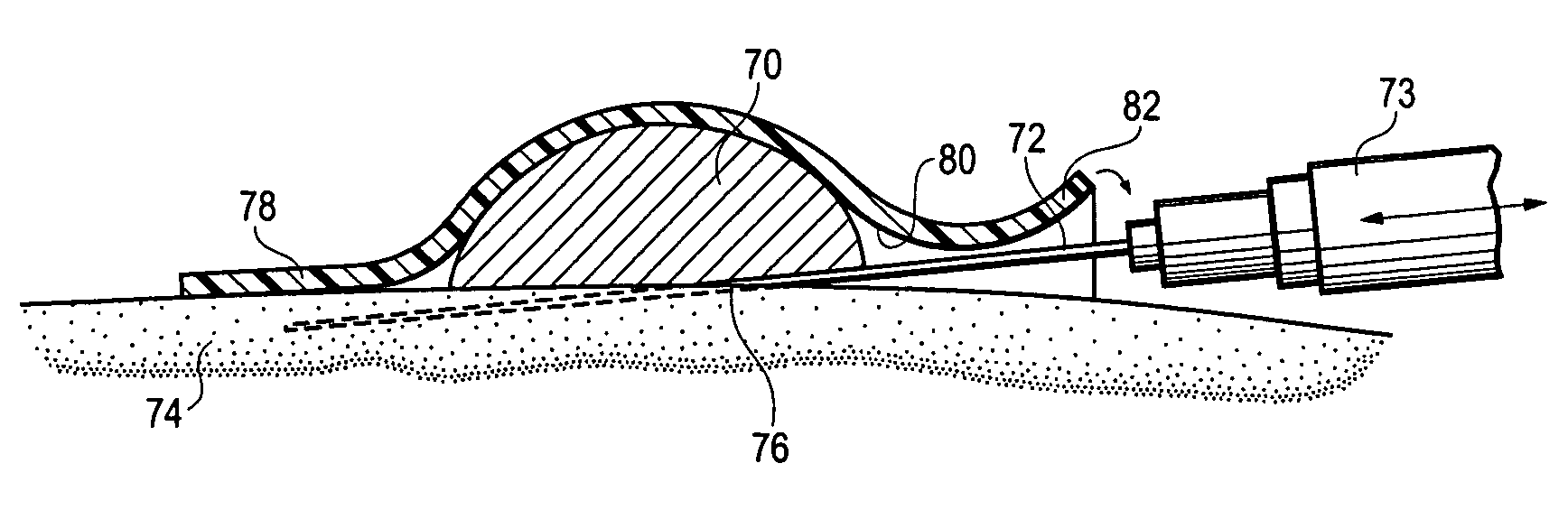 Injection and hemostasis site