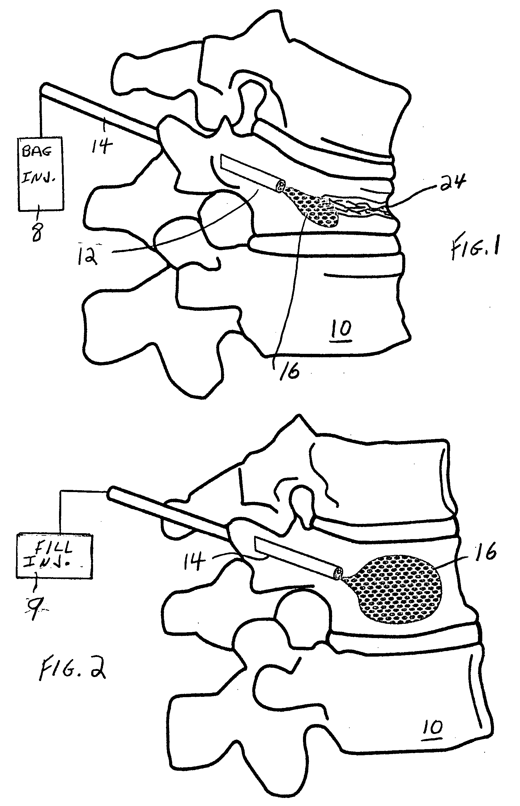 Spinal fill for disk surgery