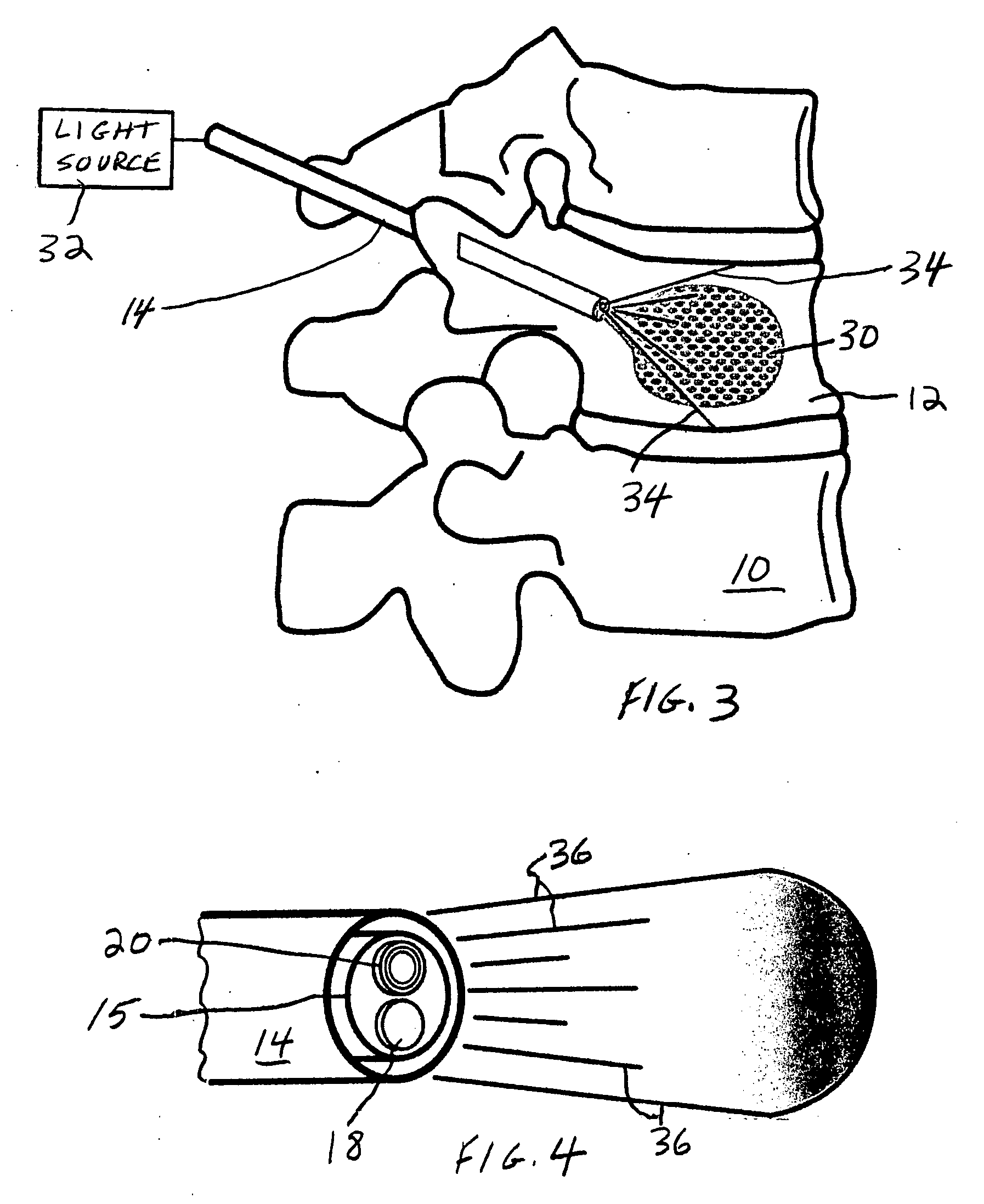 Spinal fill for disk surgery