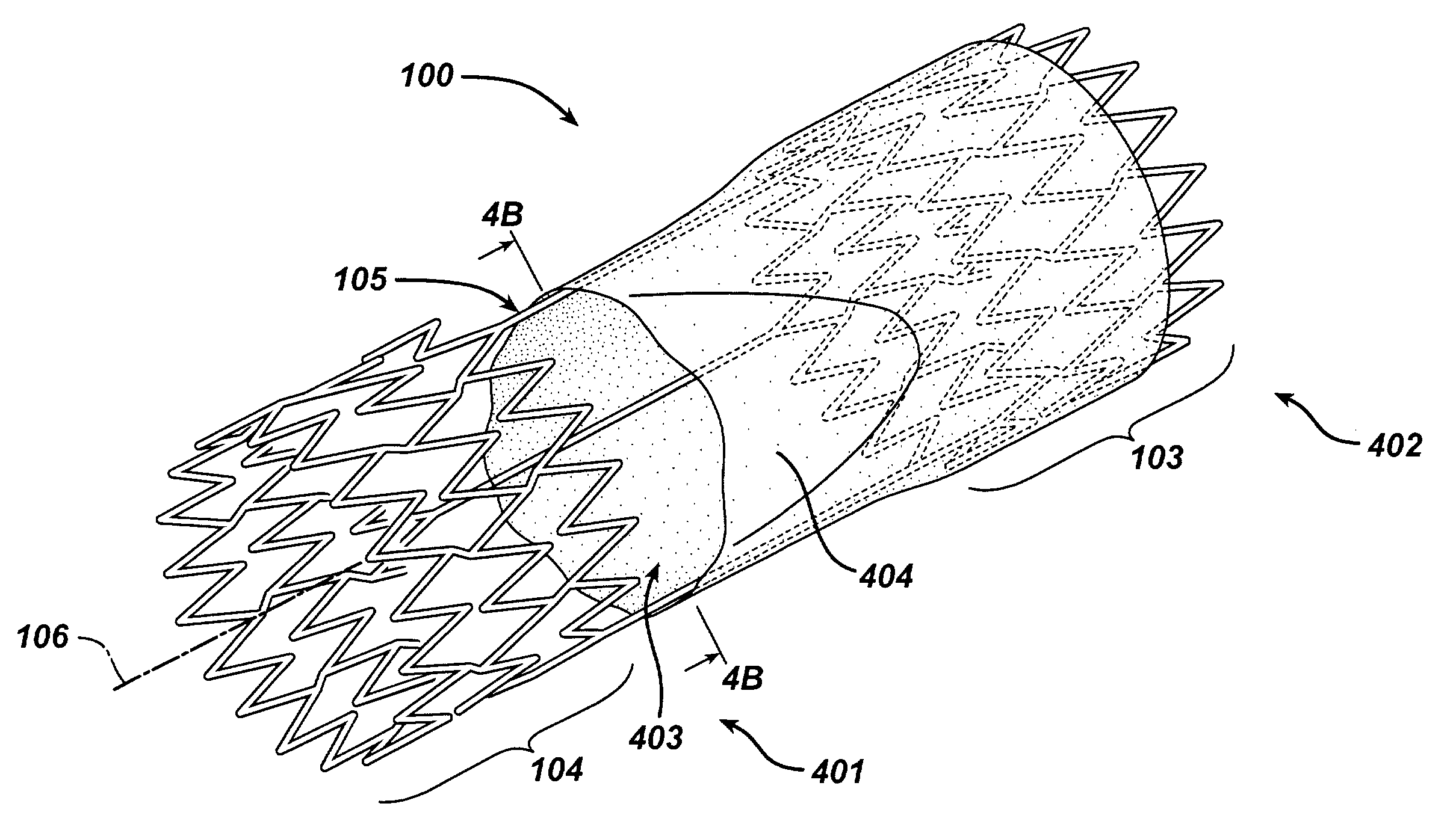 Frame based unidirectional flow prosthetic implant