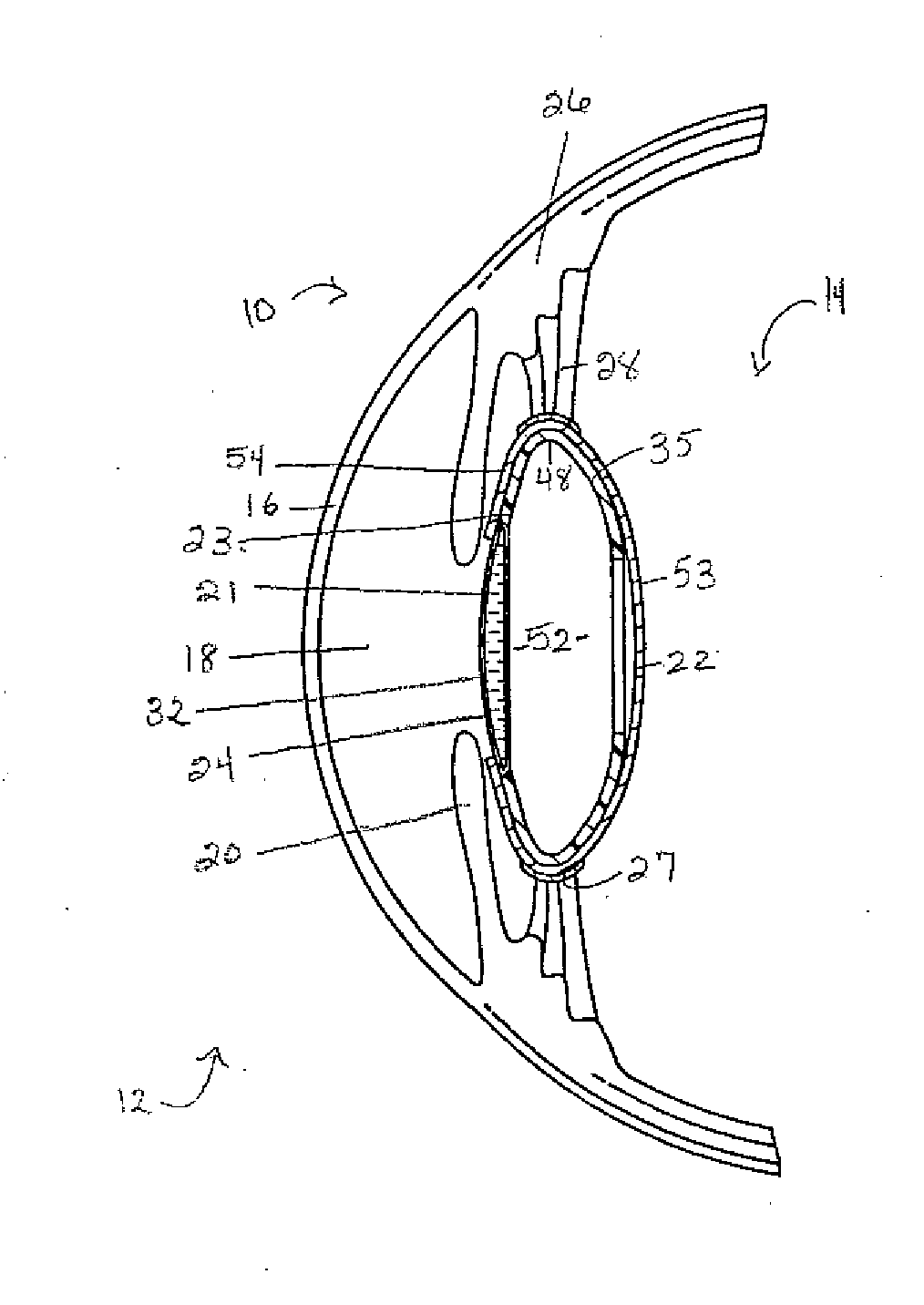 Accommodating intraocular lenses