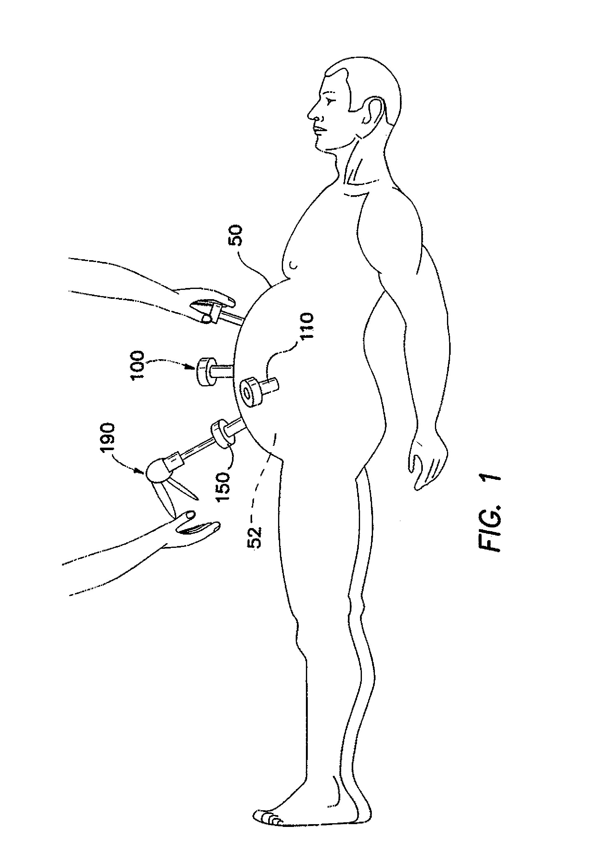 Trocar cannula assembly and method of manufacture