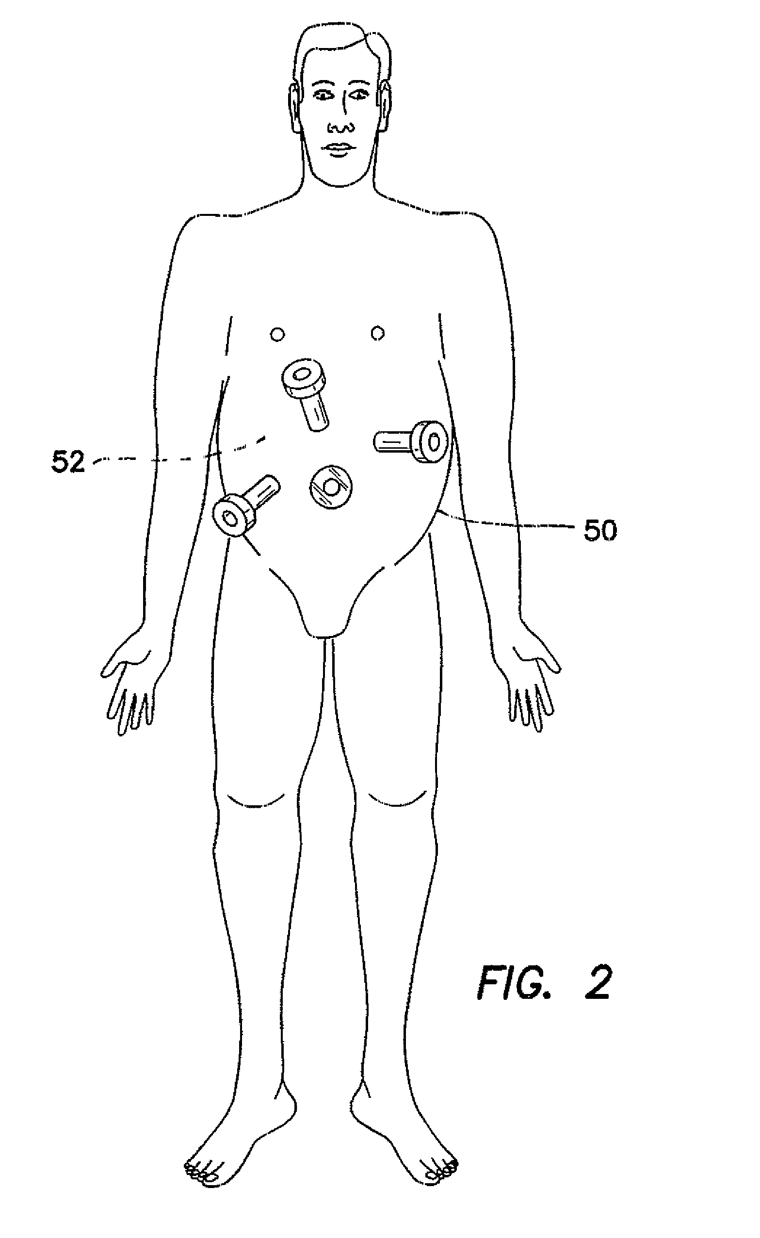 Trocar cannula assembly and method of manufacture