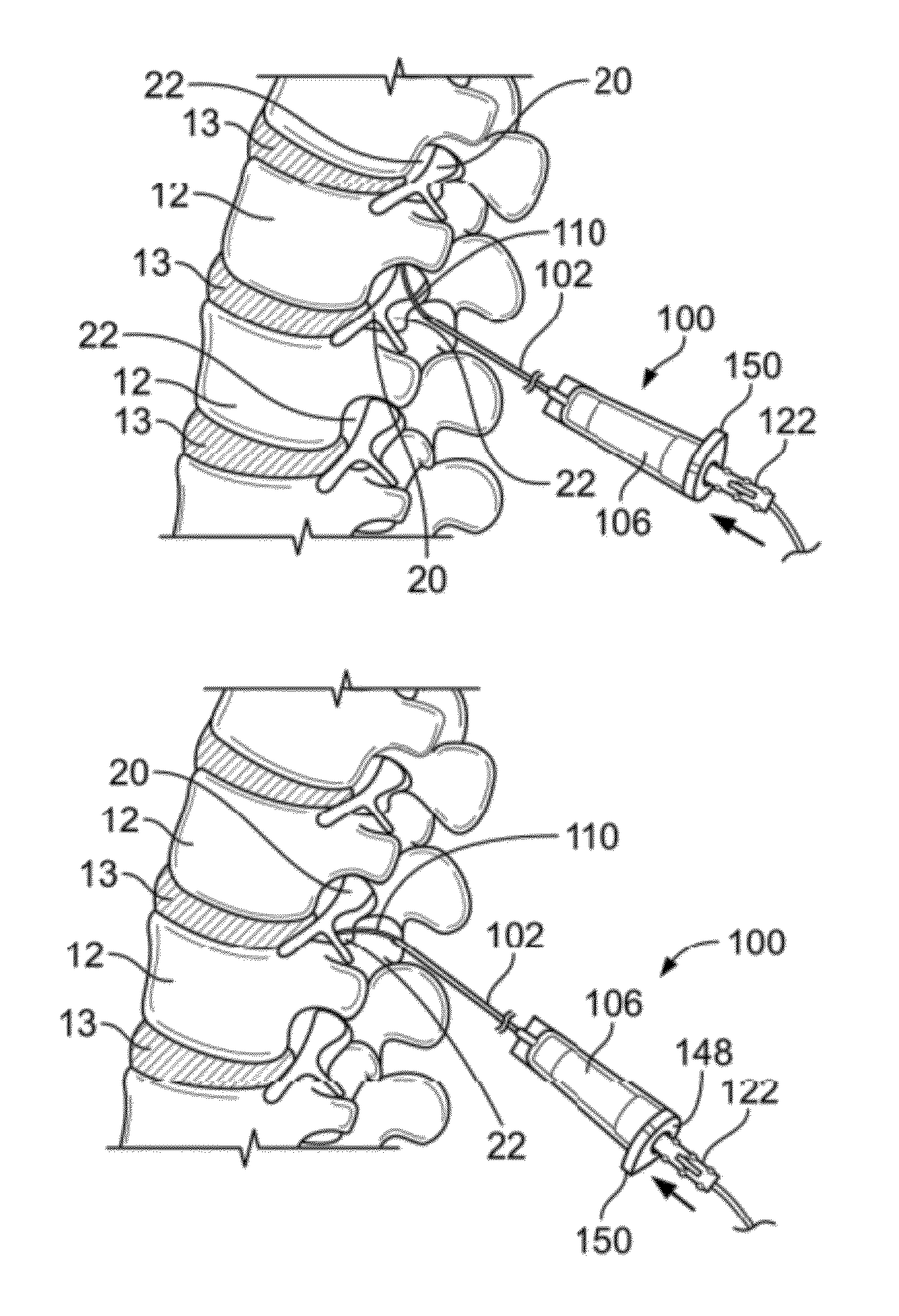 Method of accessing two lateral recesses