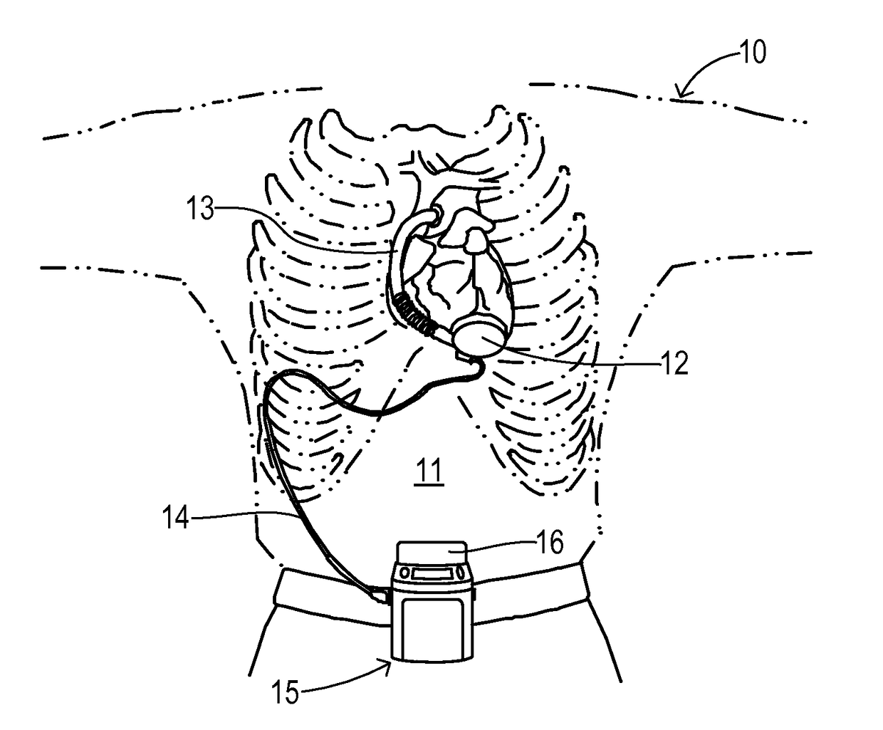 Cardiac pump with speed adapted for ventricle unloading