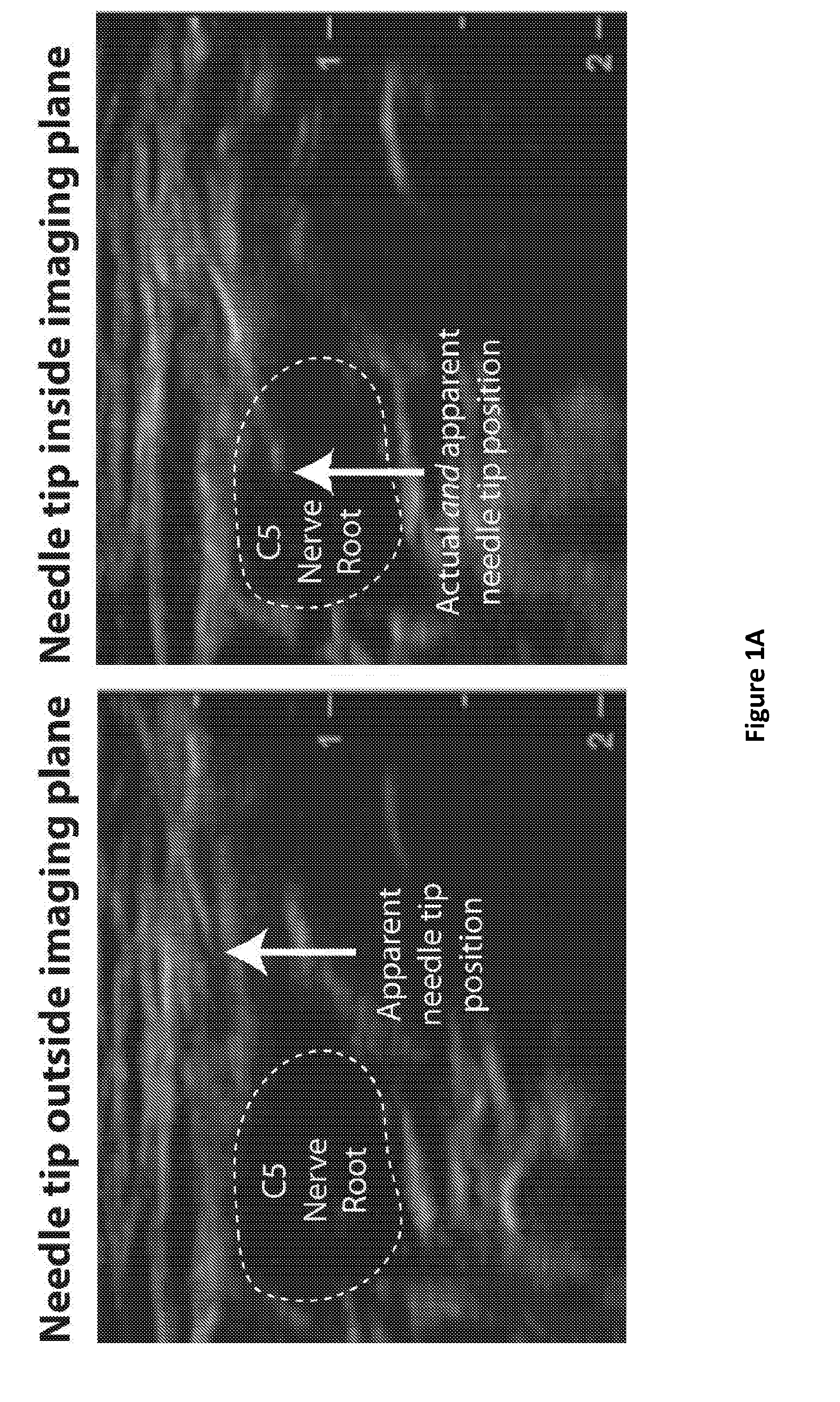 A method and apparatus for determining the location of a medical instrument with respect to ultrasound imaging, and a medical instrument to facilitate such determination