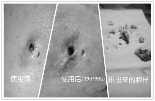 Traditional Chinese medicine composition for treating abscess and furuncle, and preparation method and application of traditional Chinese medicine composition