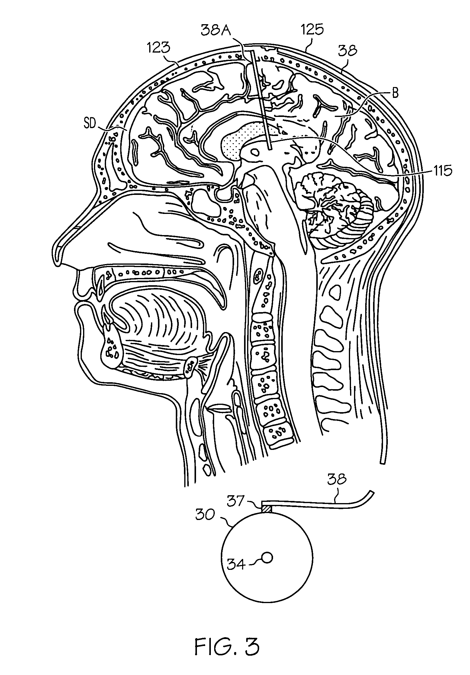 Pump systems including injectable gabapentin compositions