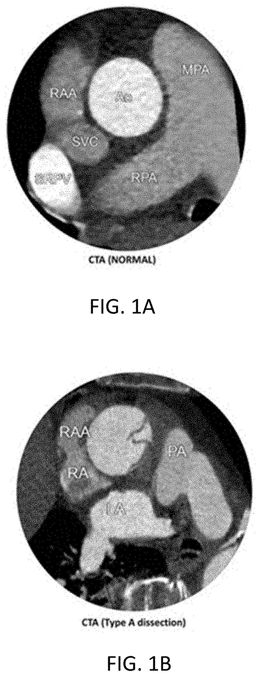 Transcatheter device, system and method for treating type a aortic dissection