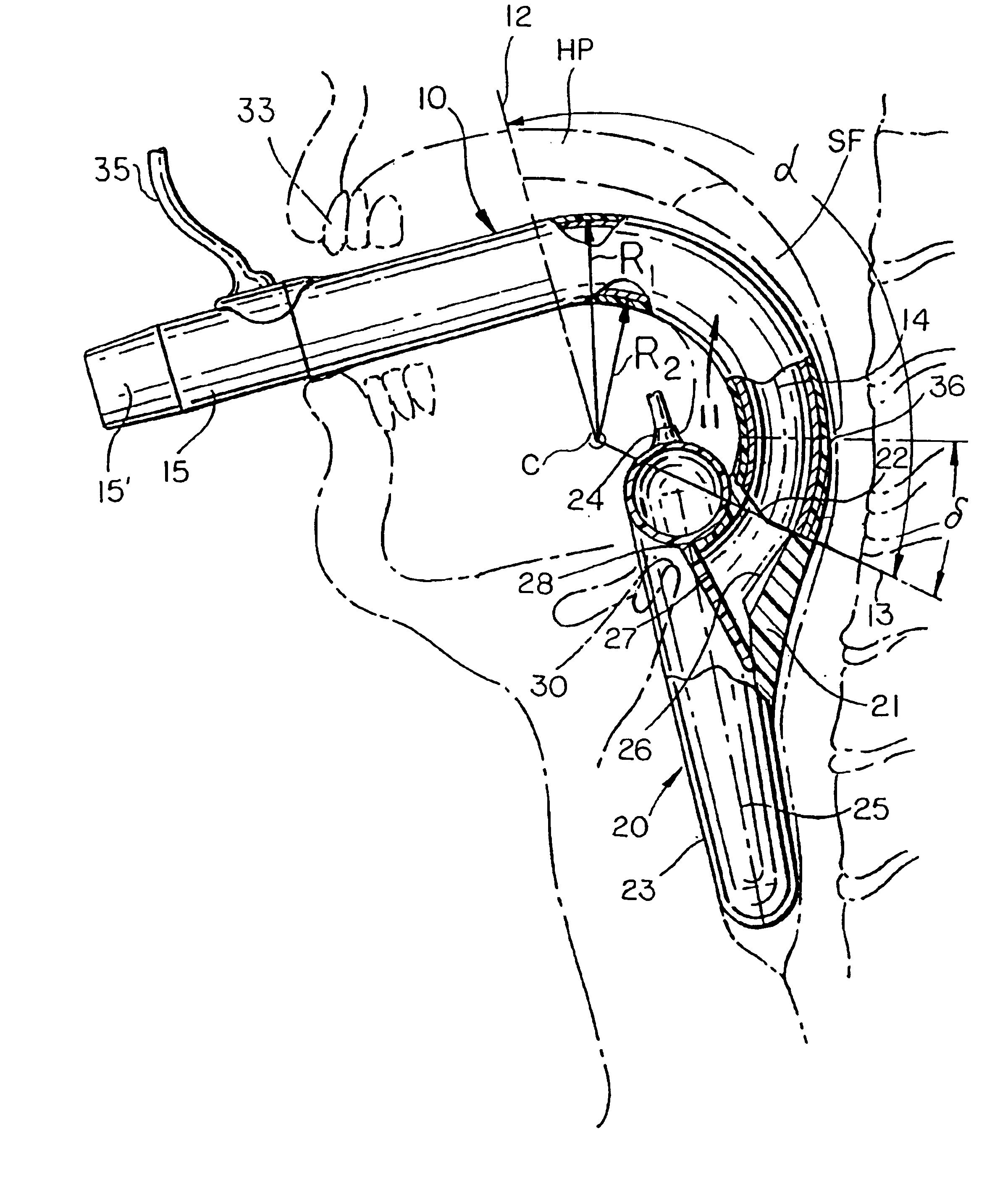 Intubating laryngeal mask