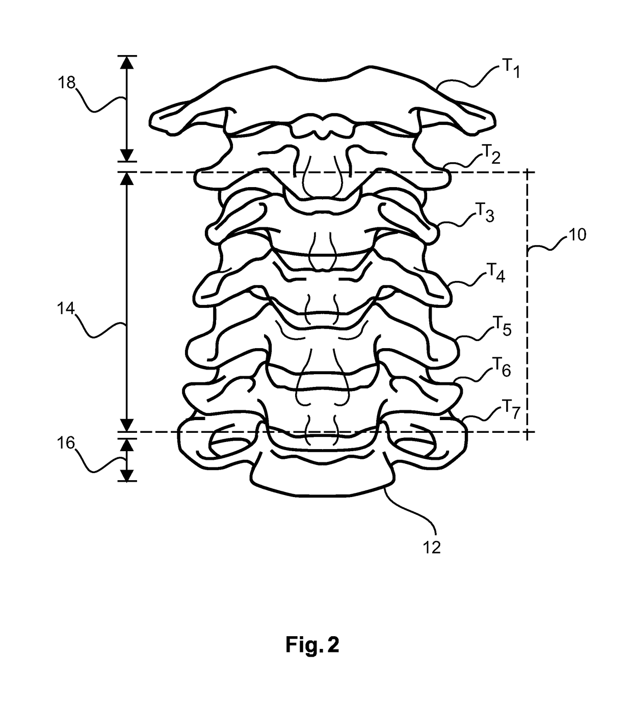 Vertebral feature identification