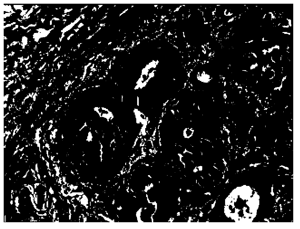 Ming classification human expansive type gastric cancer cell line and application thereof