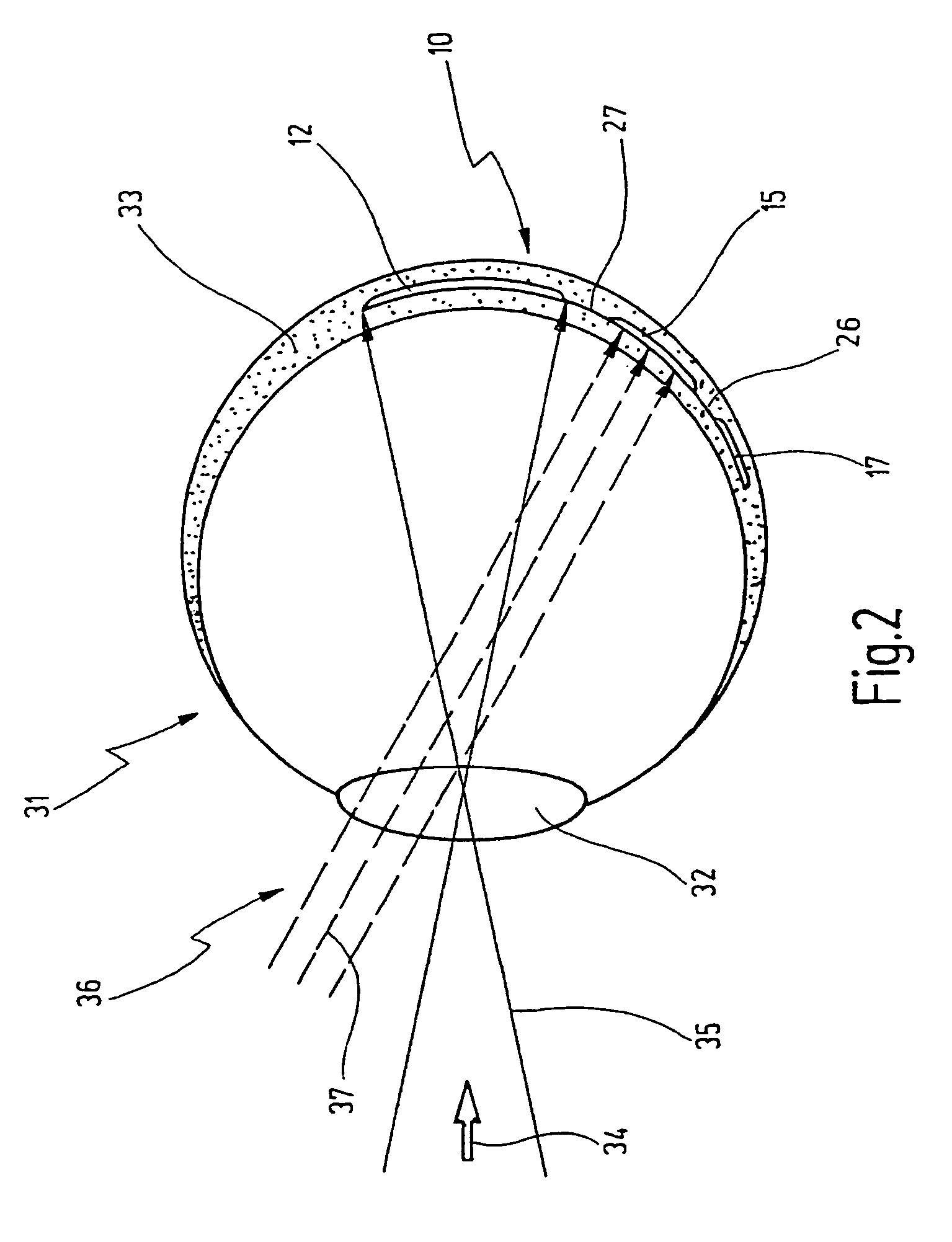 Active retina implant with a multiplicity of pixel elements