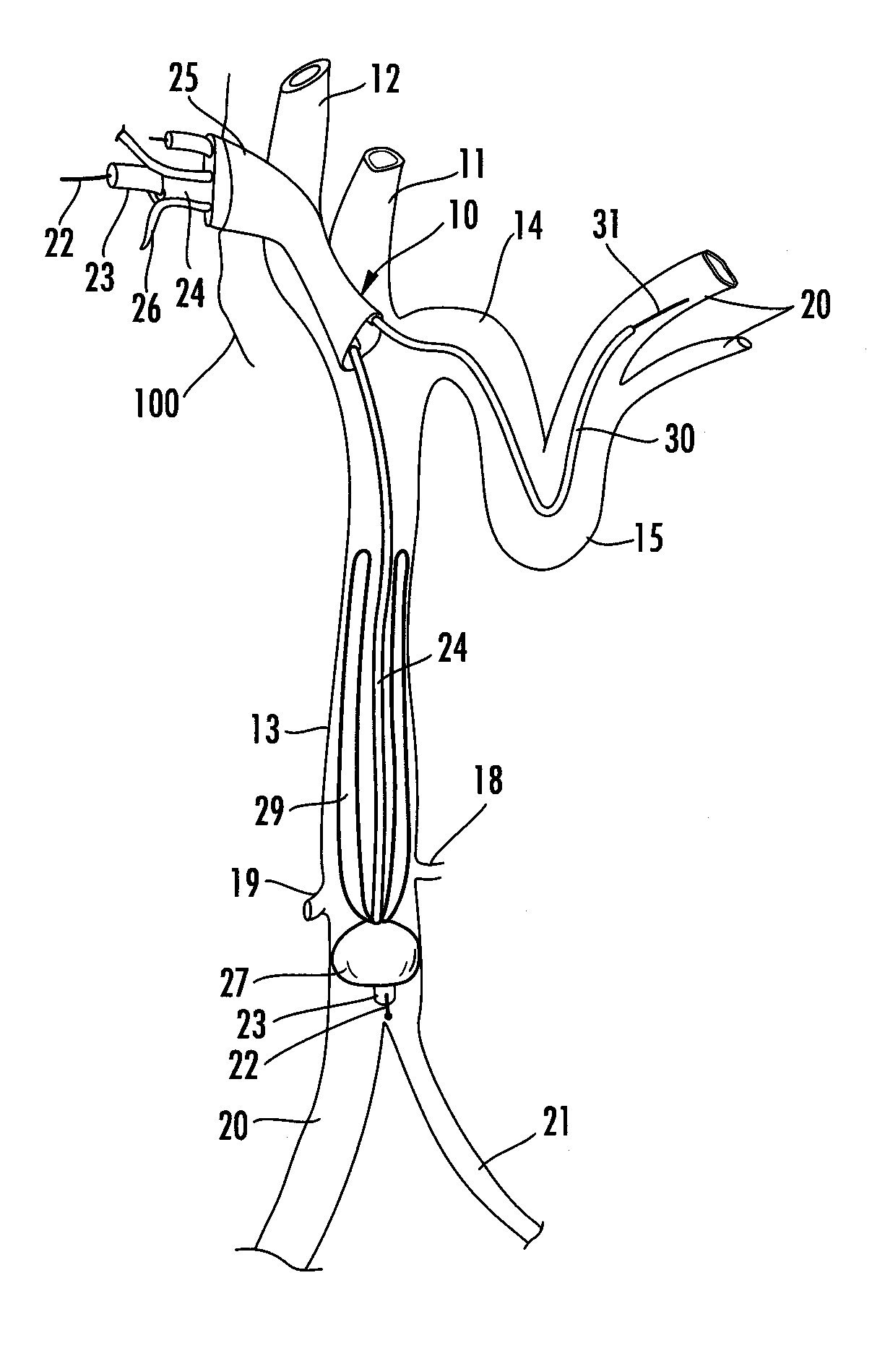 Catheter for treatment of severe pulmonary emboli