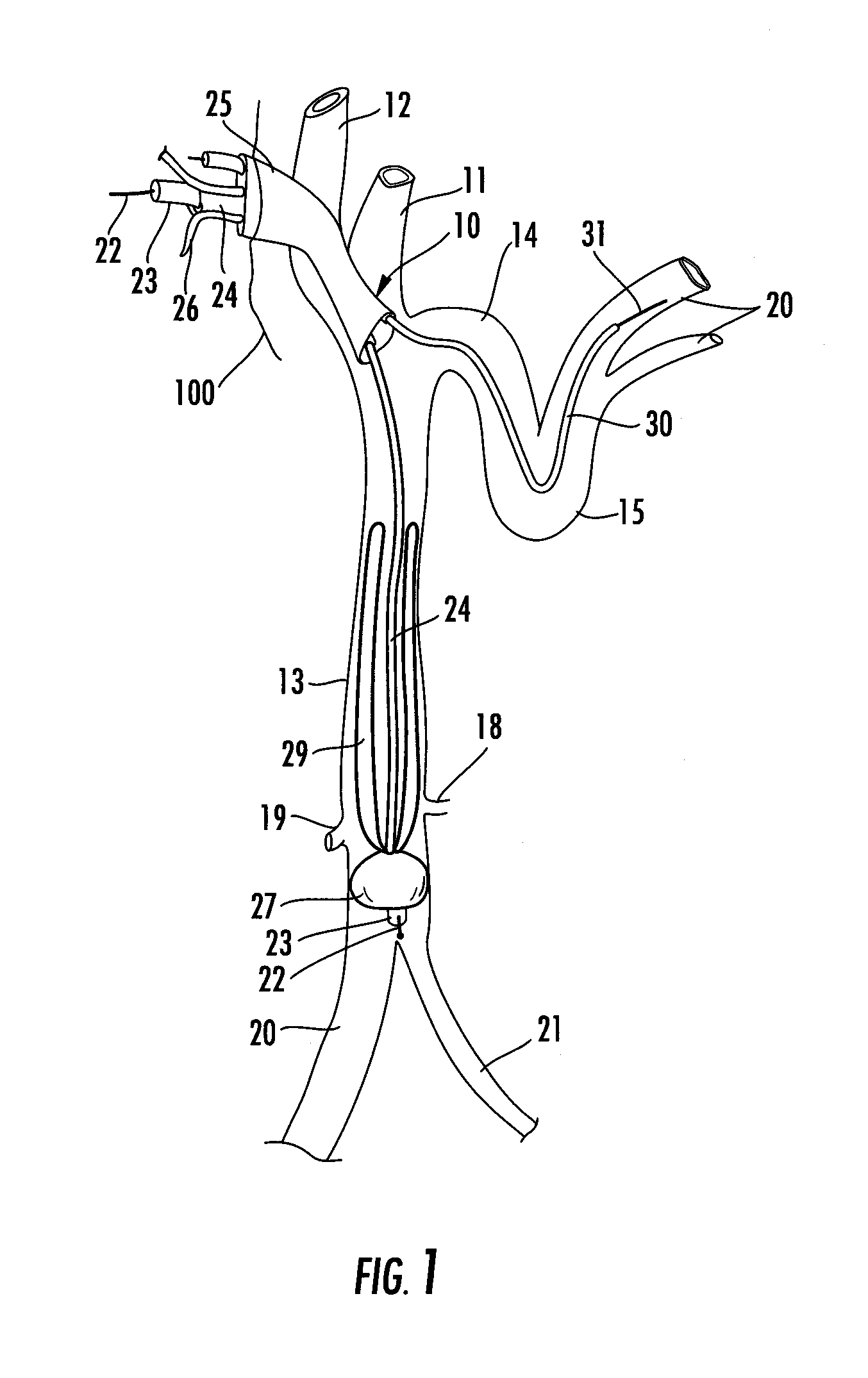 Catheter for treatment of severe pulmonary emboli