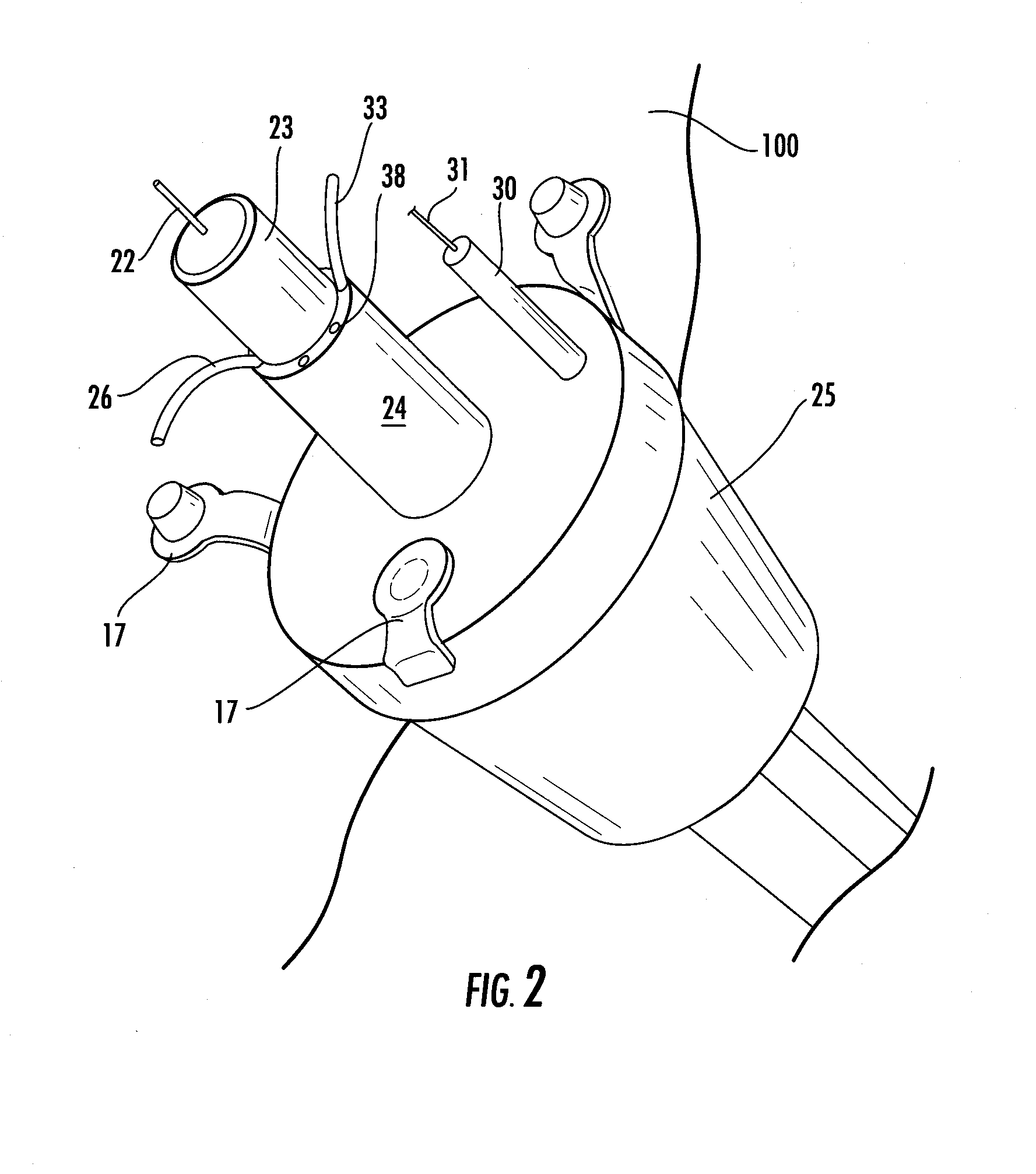 Catheter for treatment of severe pulmonary emboli