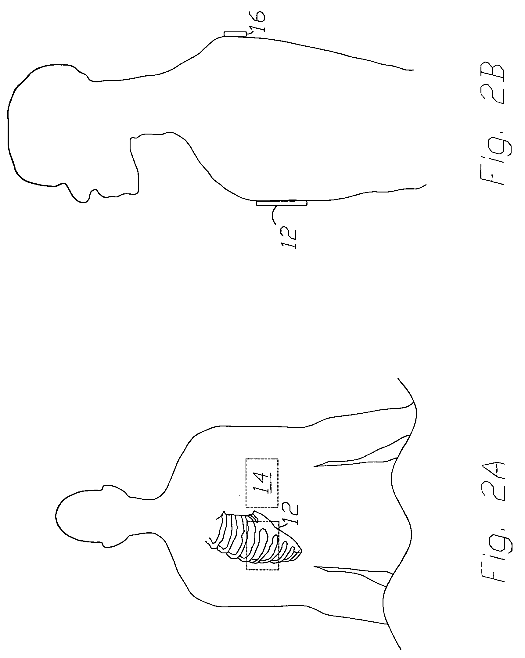 Wireless transmitted electrocardiogram monitoring device