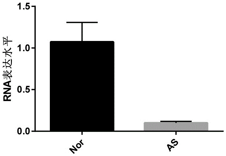 Biomarker for detecting occlusion or stenosis of coronary artery and preparation method thereof, and reagent kit containing biomarker