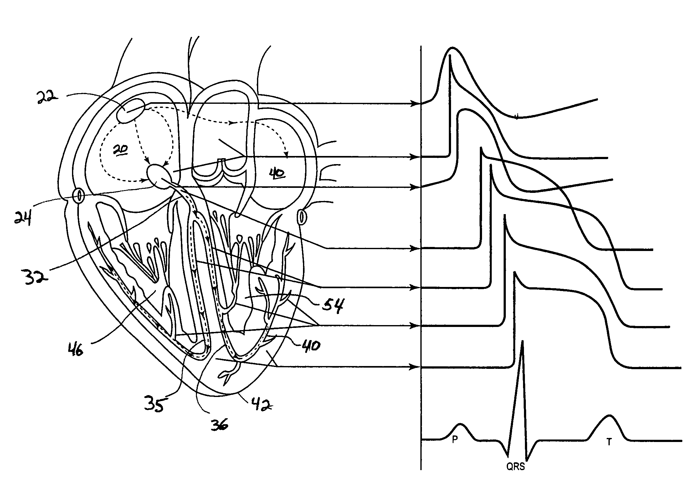 System and method of AV interval selection in an implantable medical device