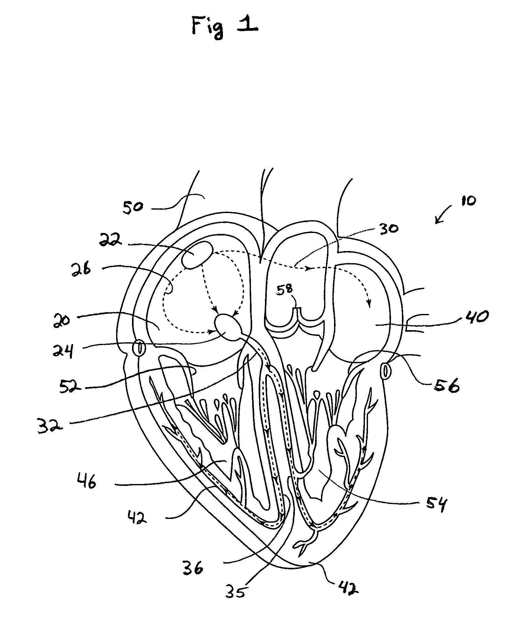 System and method of AV interval selection in an implantable medical device