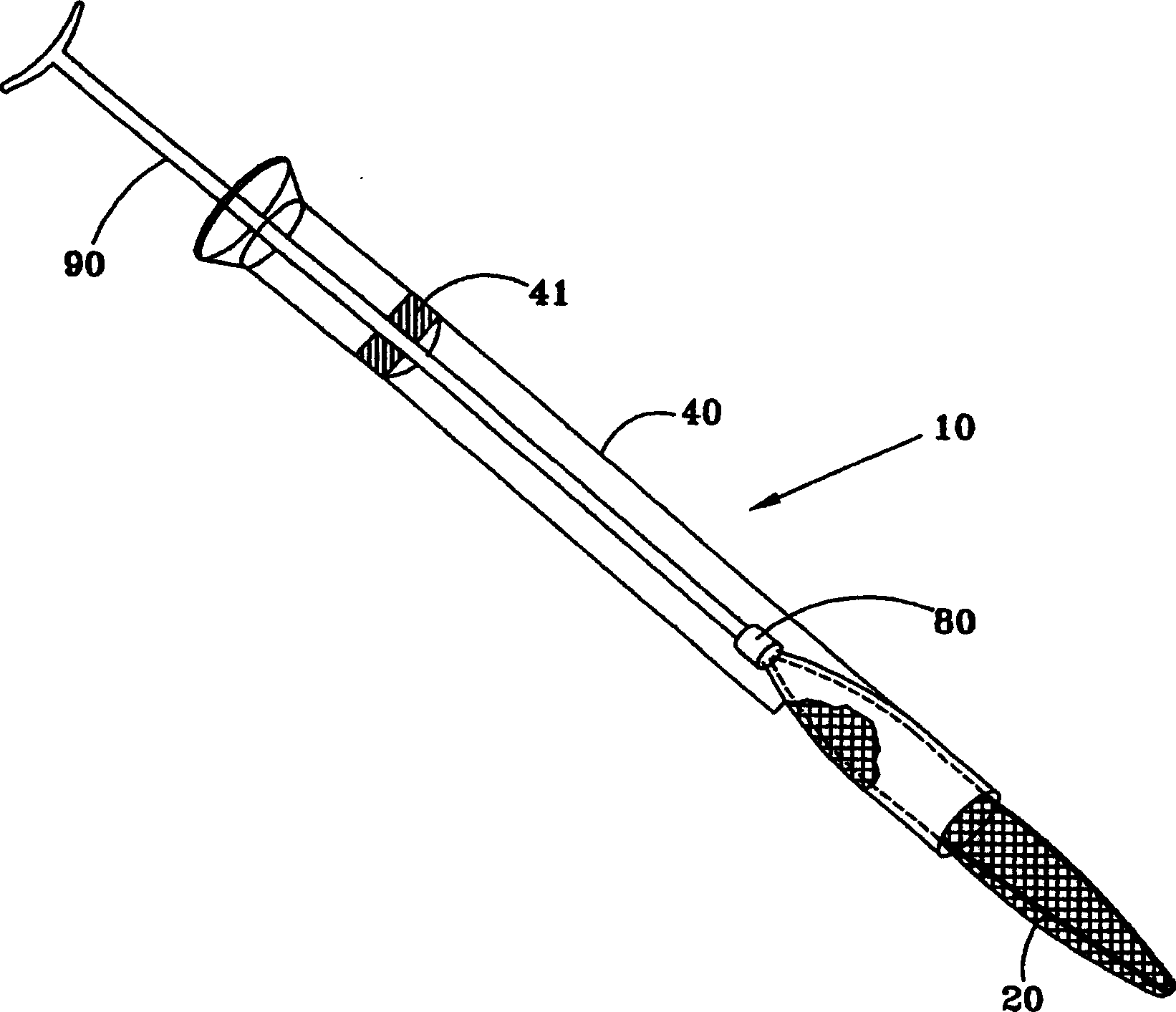 Laparoscopic stone safety device and method