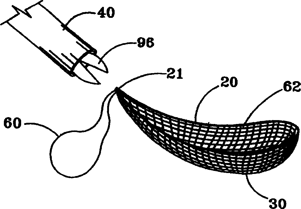 Laparoscopic stone safety device and method