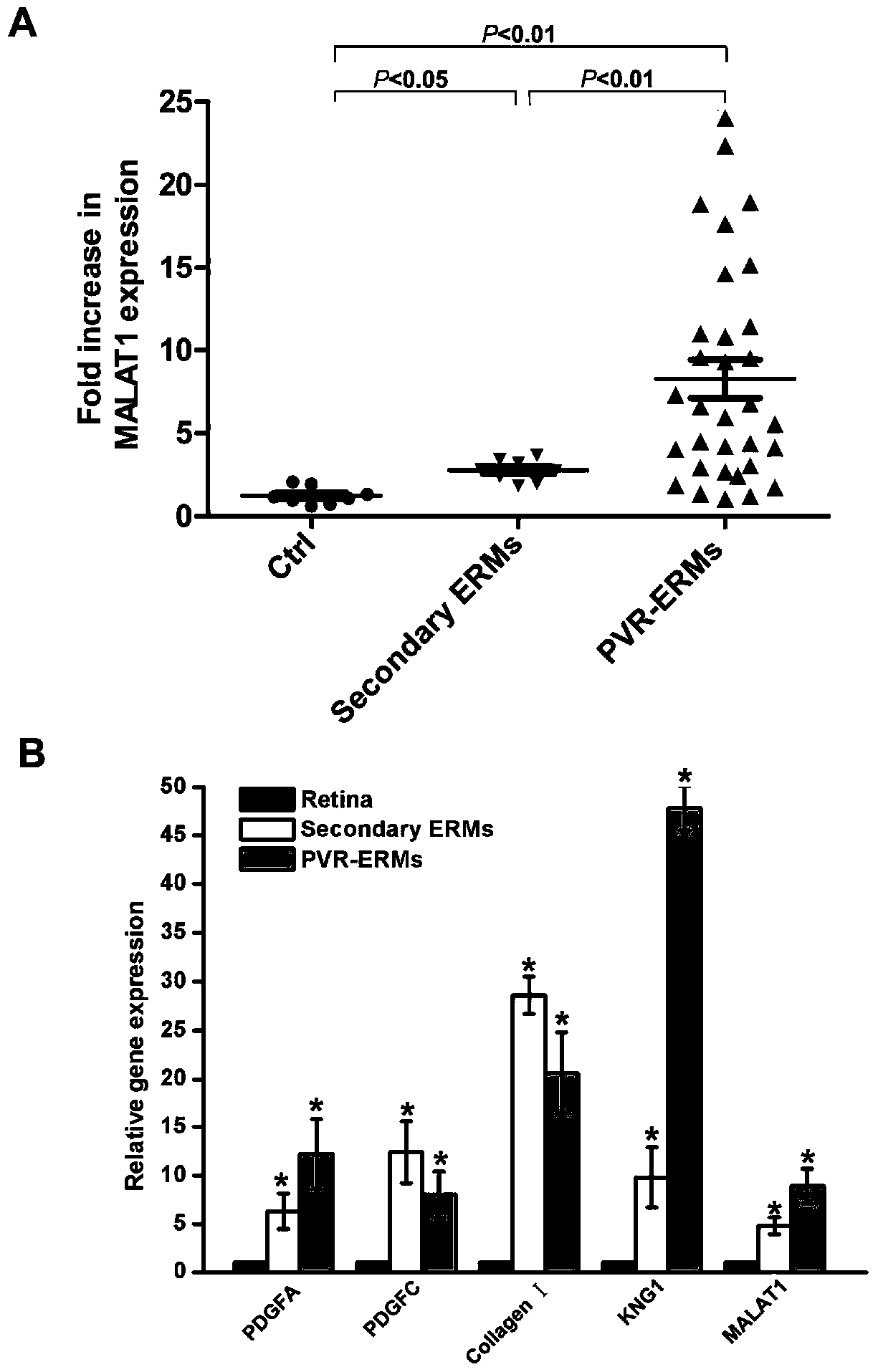 Application of lncrna-malat1 in the preparation of diagnostic reagents for proliferative vitreoretinopathy