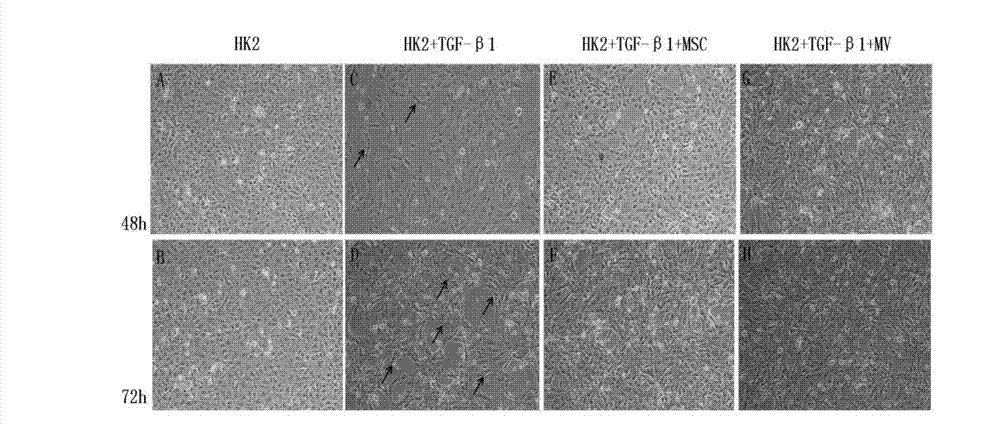 Application of microvesicles from bone marrow mesenchymal stem cells in preparing drug for treating kidney injury