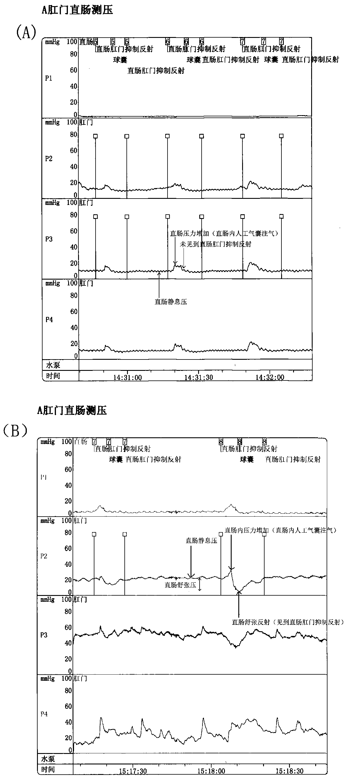 Hirschsprung's disease plasma exosome diagnosis marker and application thereof