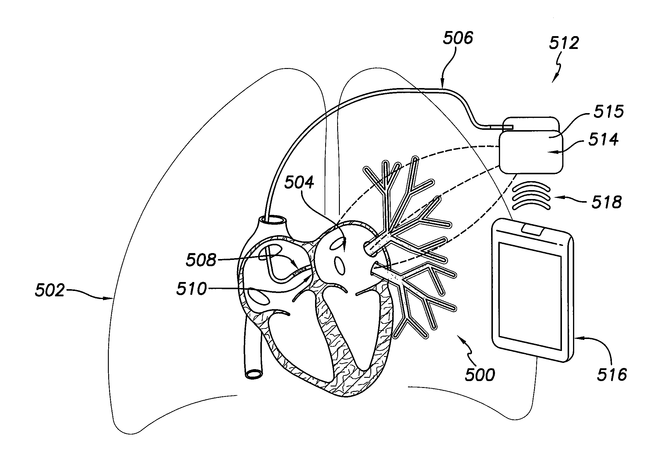 System and method for detecting and treating cardiovascular disease