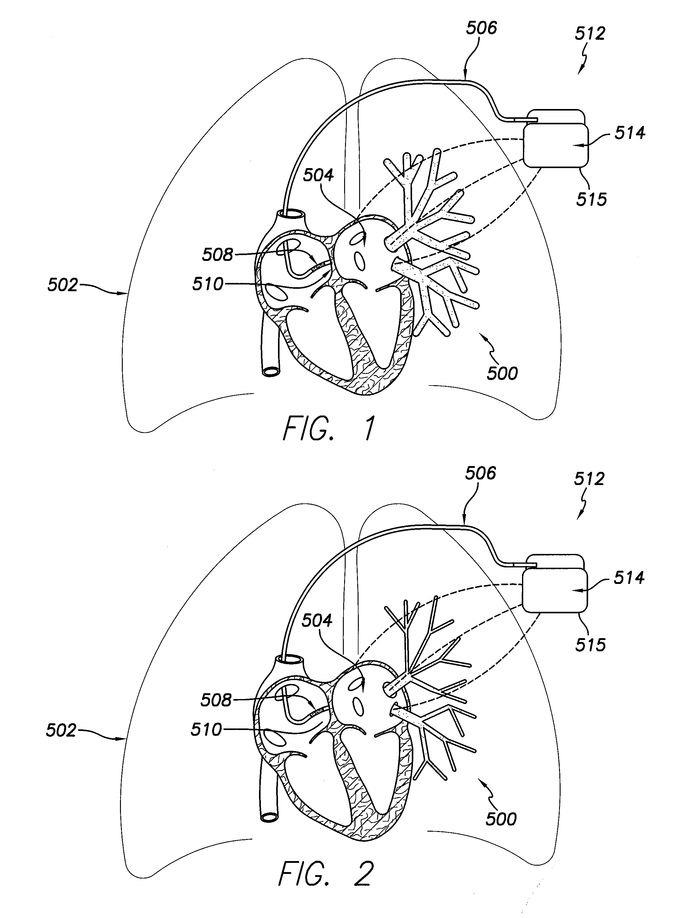 System and method for detecting and treating cardiovascular disease