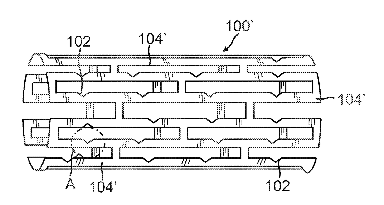 System and method for renal neuromodulation by adjustable oversized stent