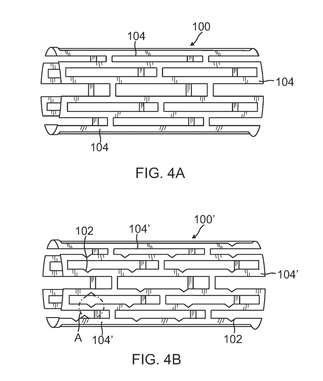 System and method for renal neuromodulation by adjustable oversized stent