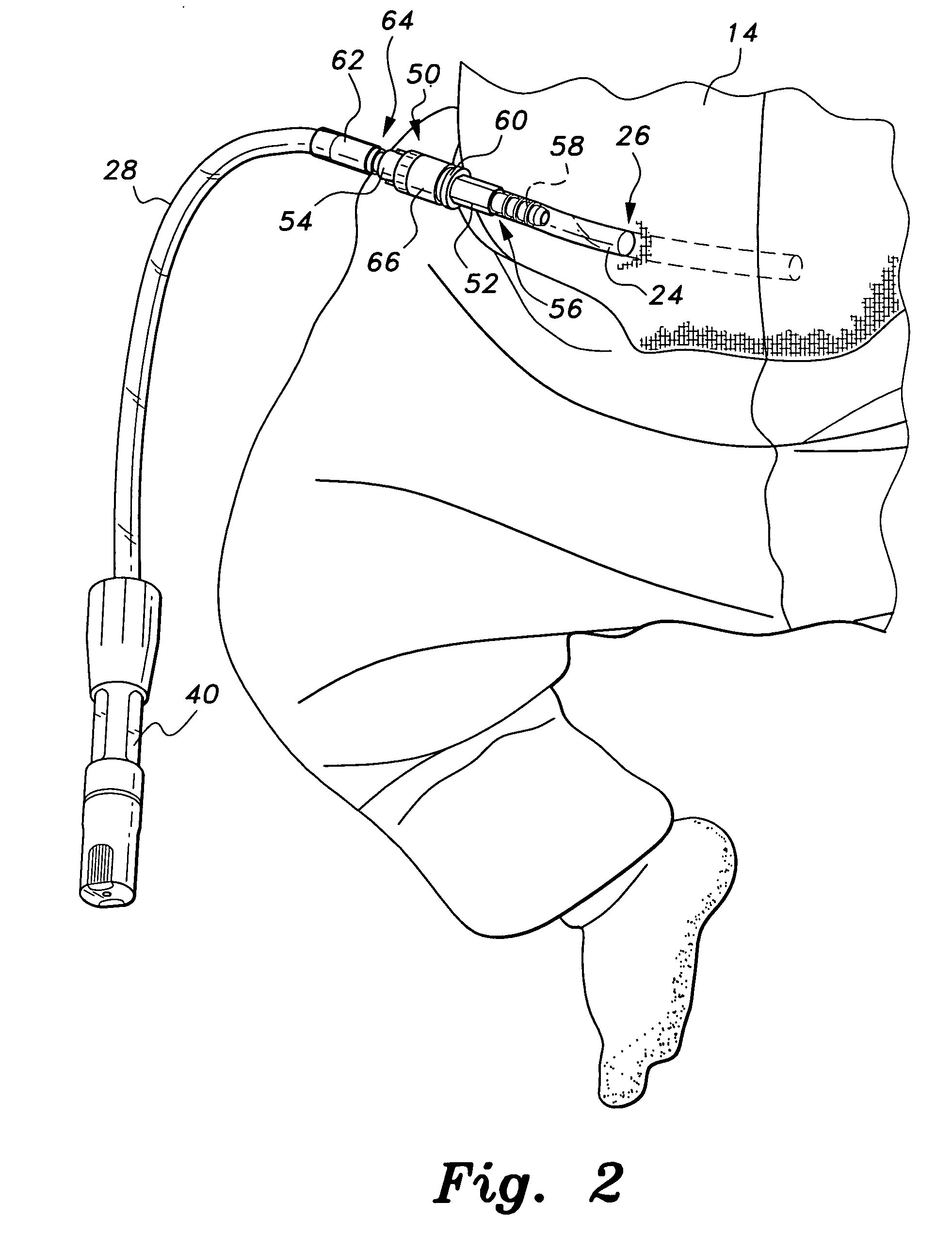 Peritoneal dialysis doll