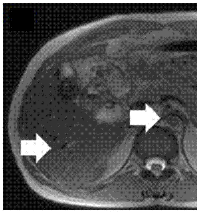 Black blood control method and system in time-reversal steady-state precession fast imaging sequence