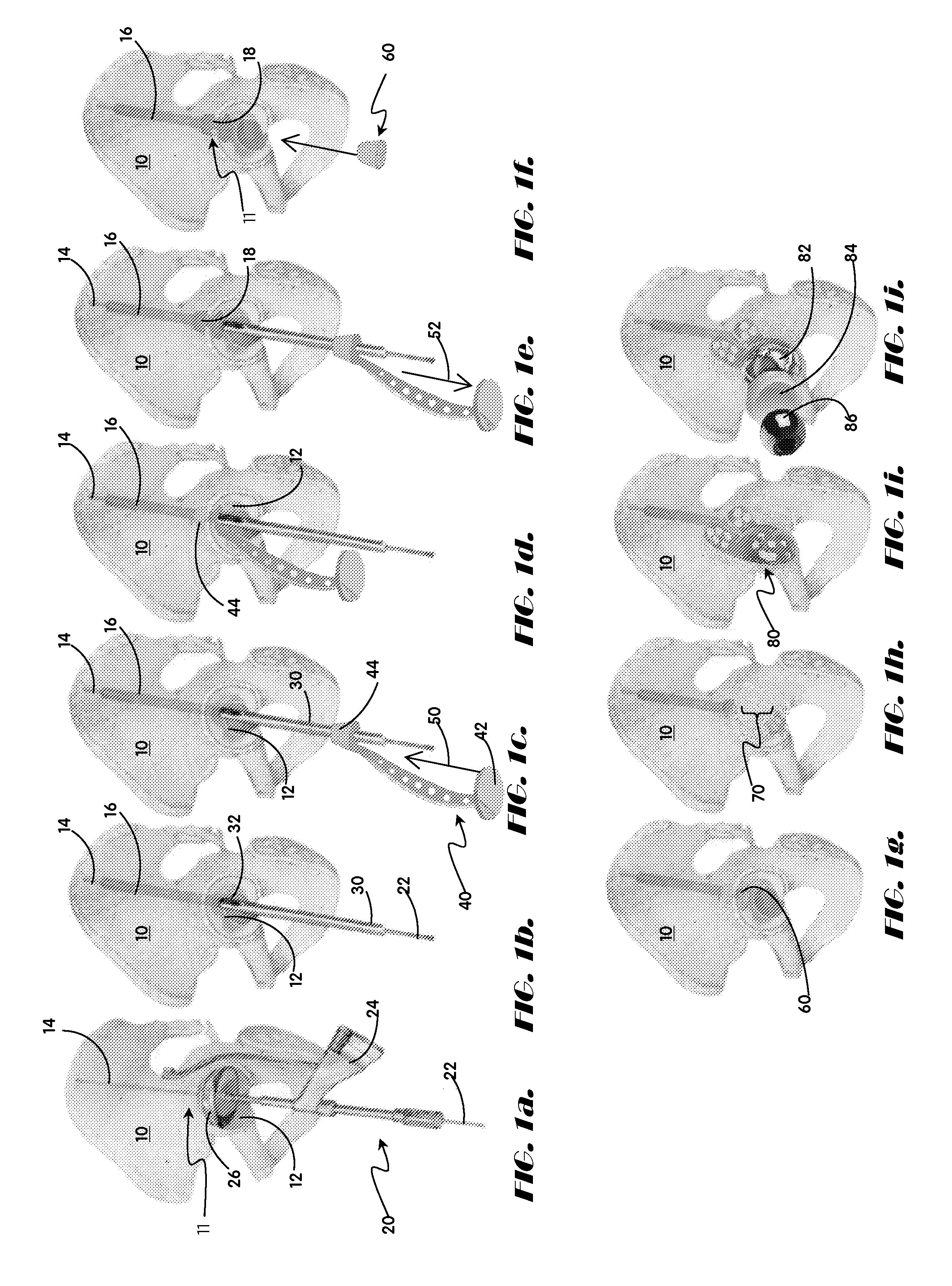 Methods and apparatus for acetabular arthroplasty