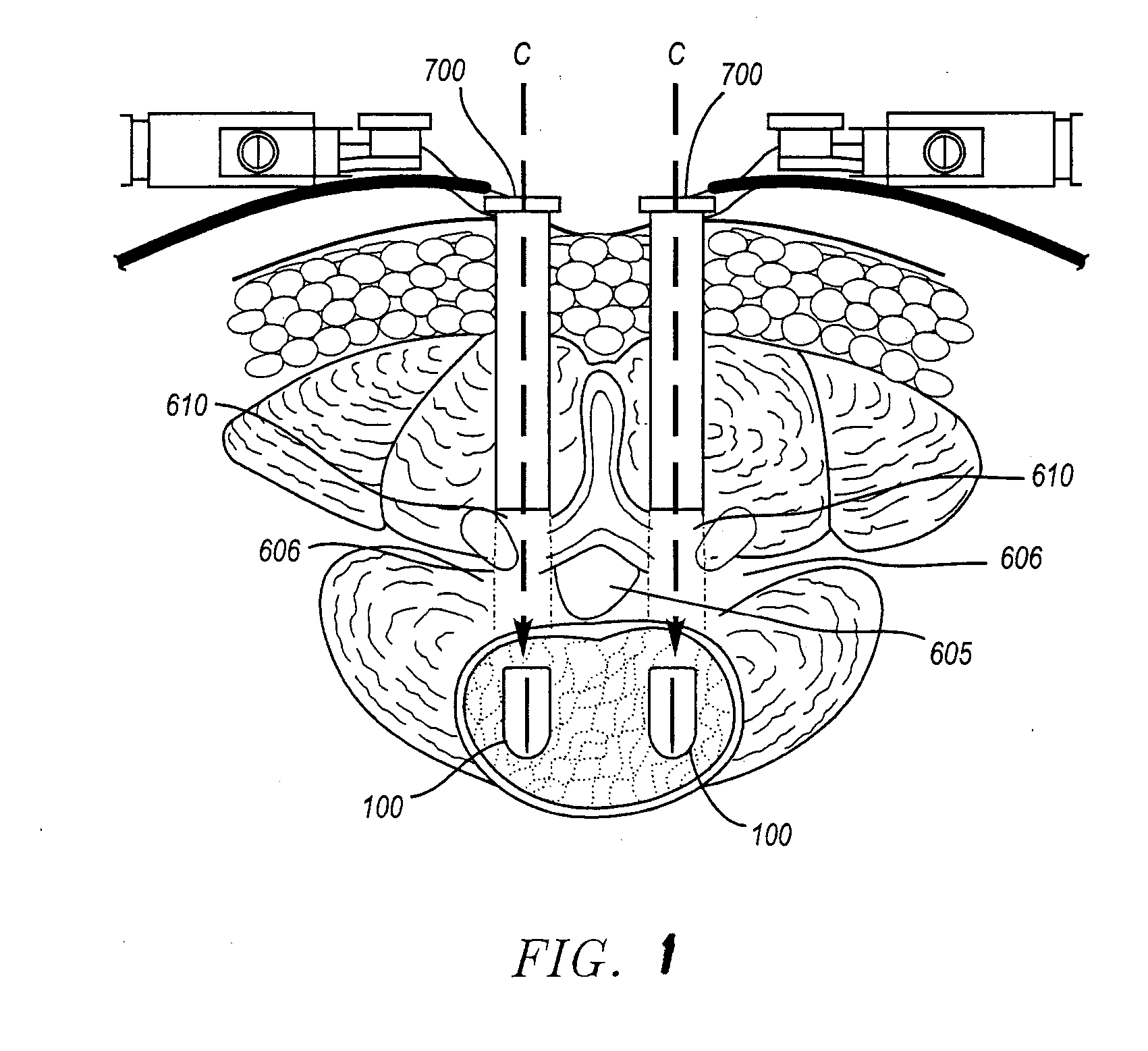 Prosthetic intervertebral discs implantable by minimally invasive surgical techniques