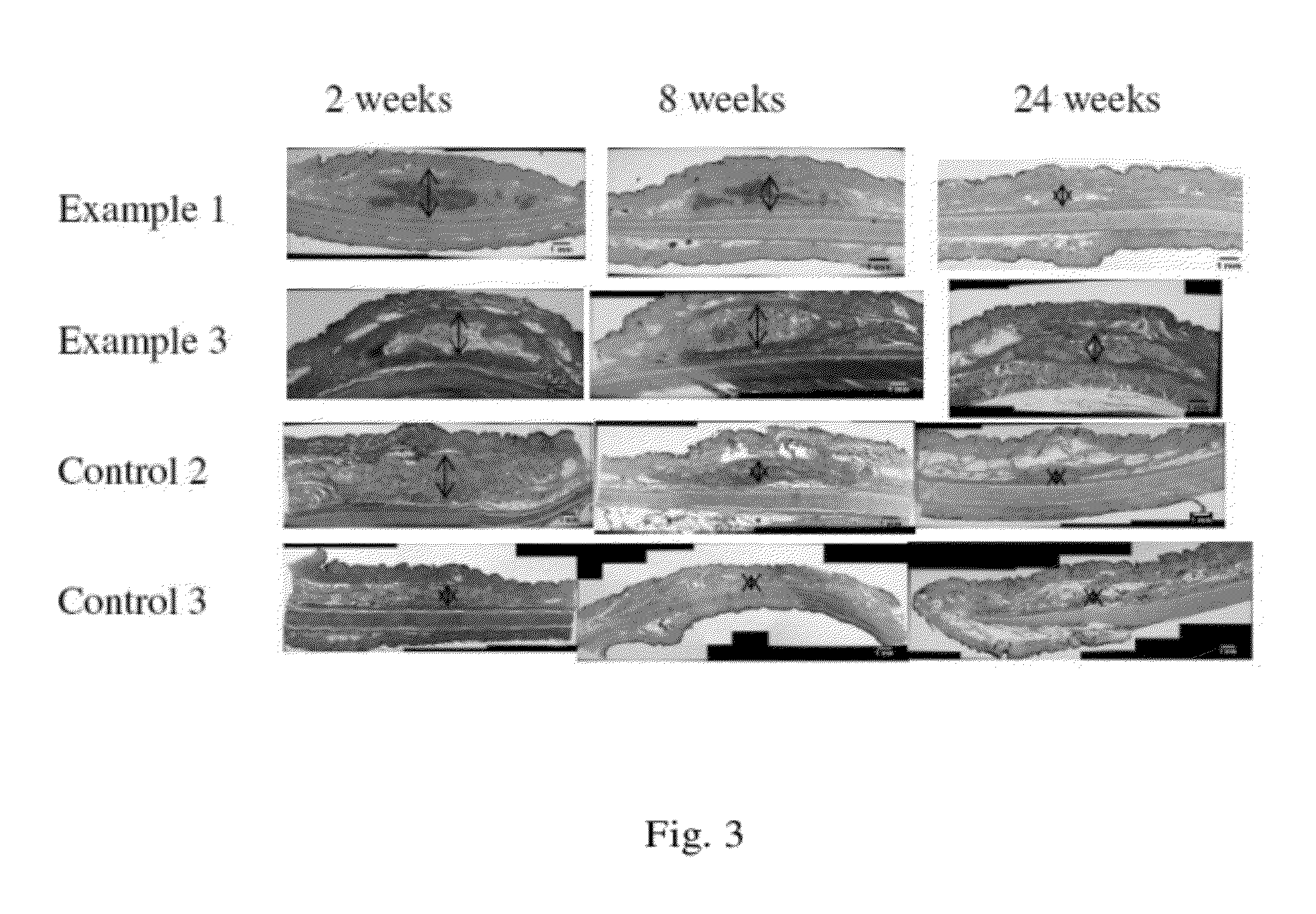 Polyelectrolyte complex gels and soft tissue augmentation implants comprising the same