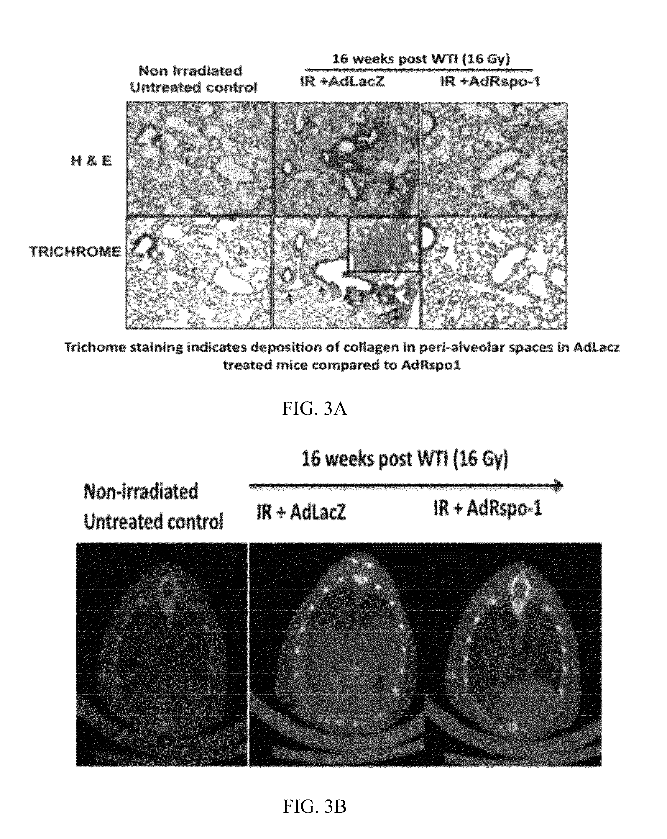 Therapy for radiation-induced lung injury