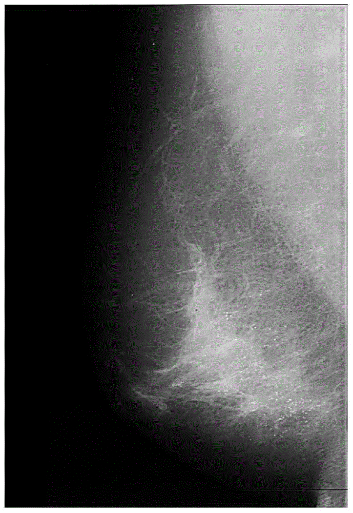 Adaptive enhancement method based on mammographic image