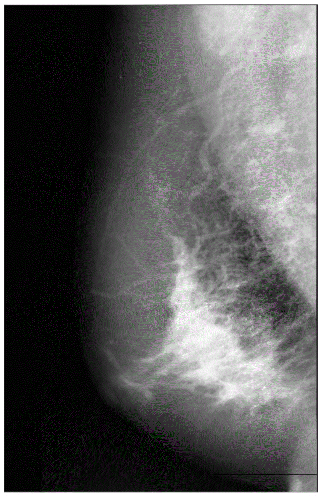 Adaptive enhancement method based on mammographic image