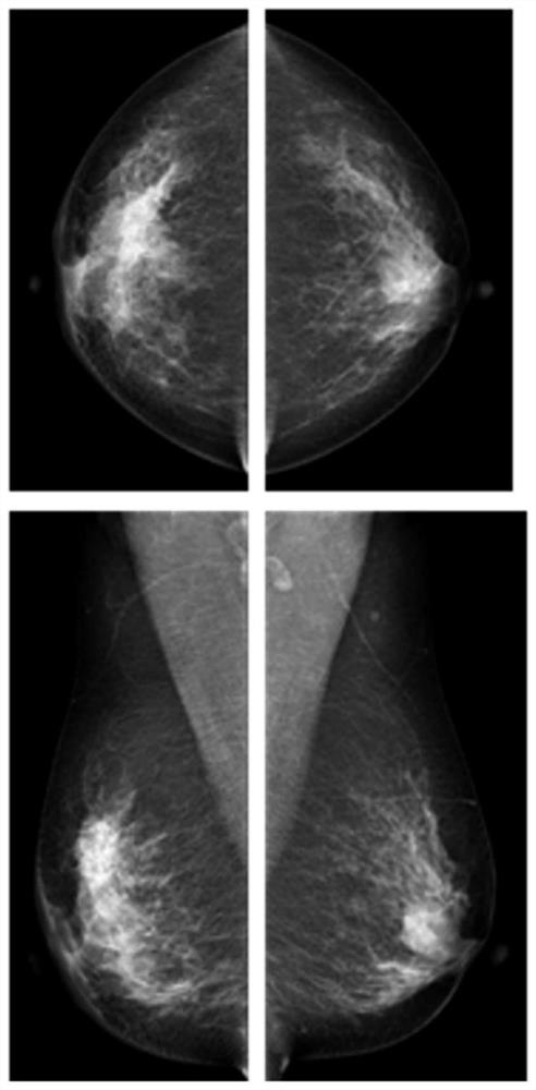 Method and device for fully convolutional single-stage breast image lesion detection based on multiple images