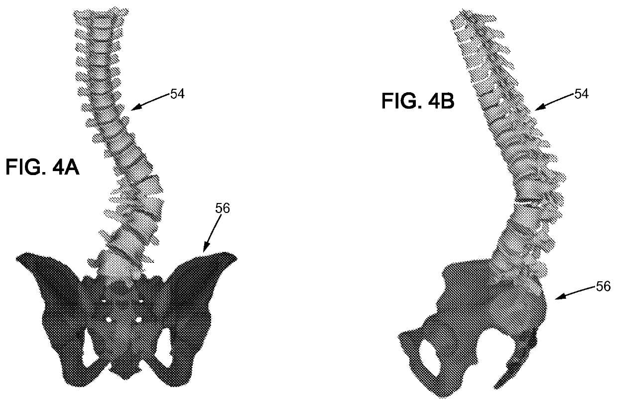 Method for designing a patient specific orthopaedic device