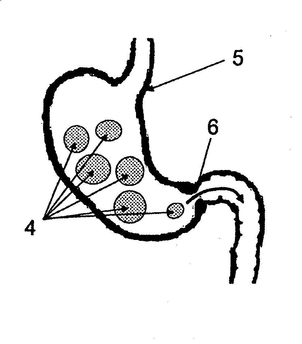 Ingestible formulations for transient, noninvasive reduction of gastric volume