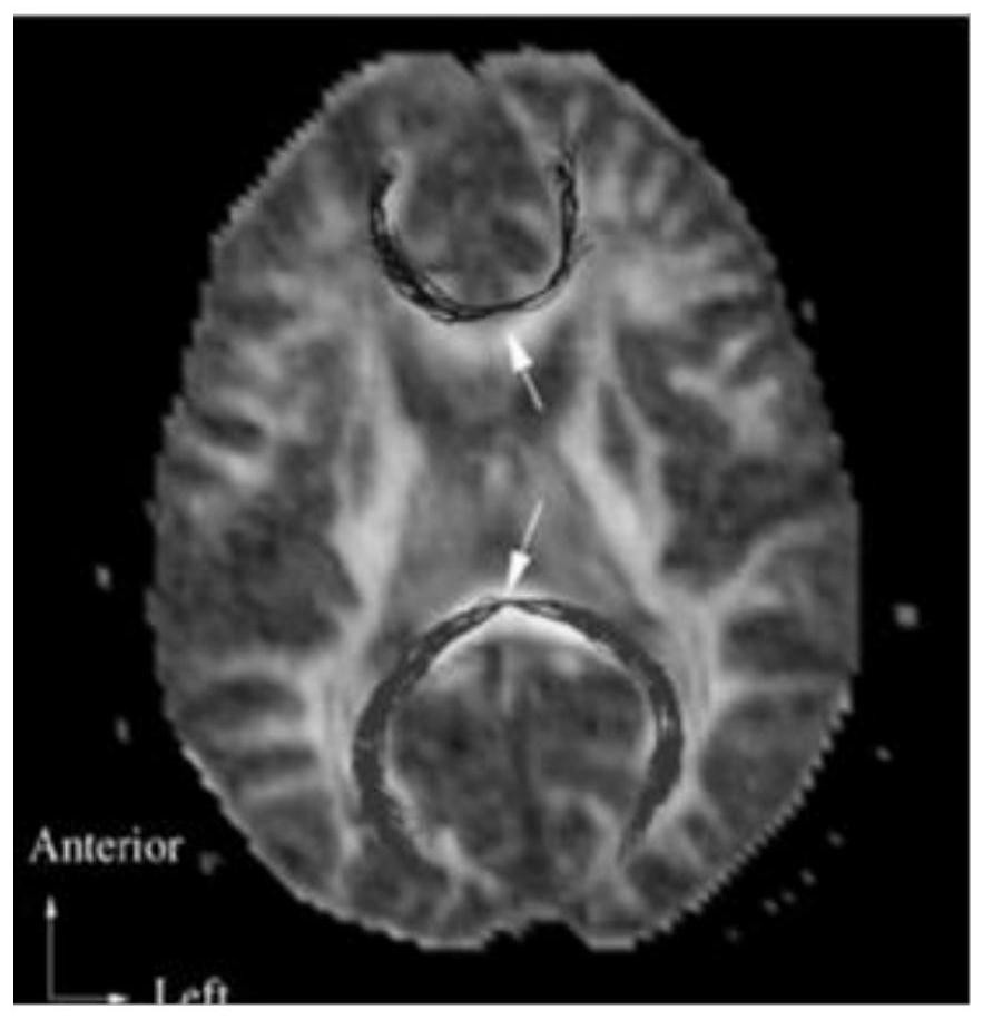 White matter fiber bundle tracking method