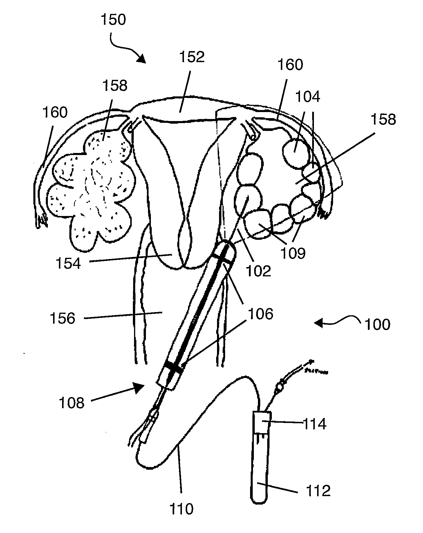 Sampling needle