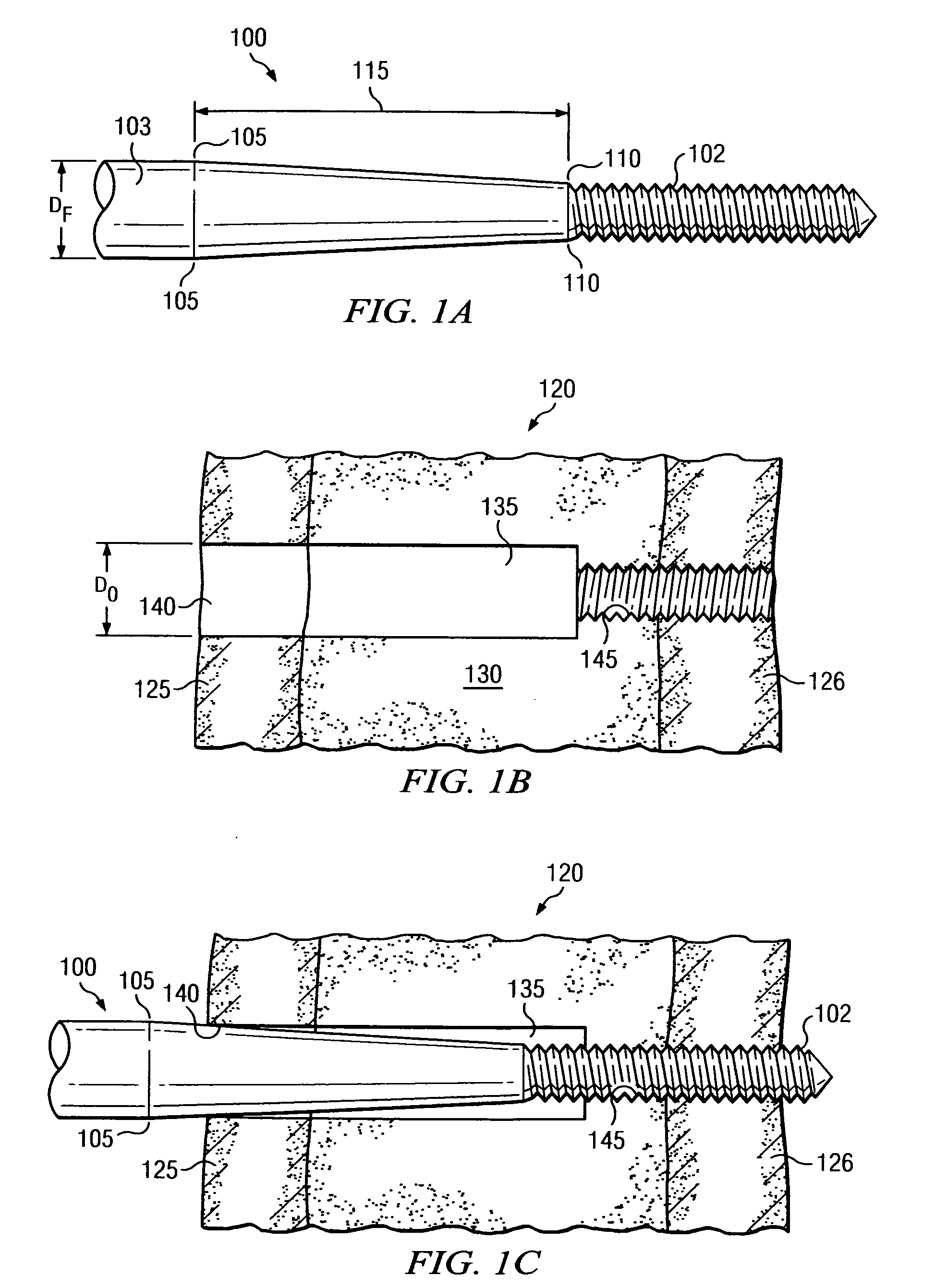 Engaging predetermined radial preloads in securing an orthopedic fastener