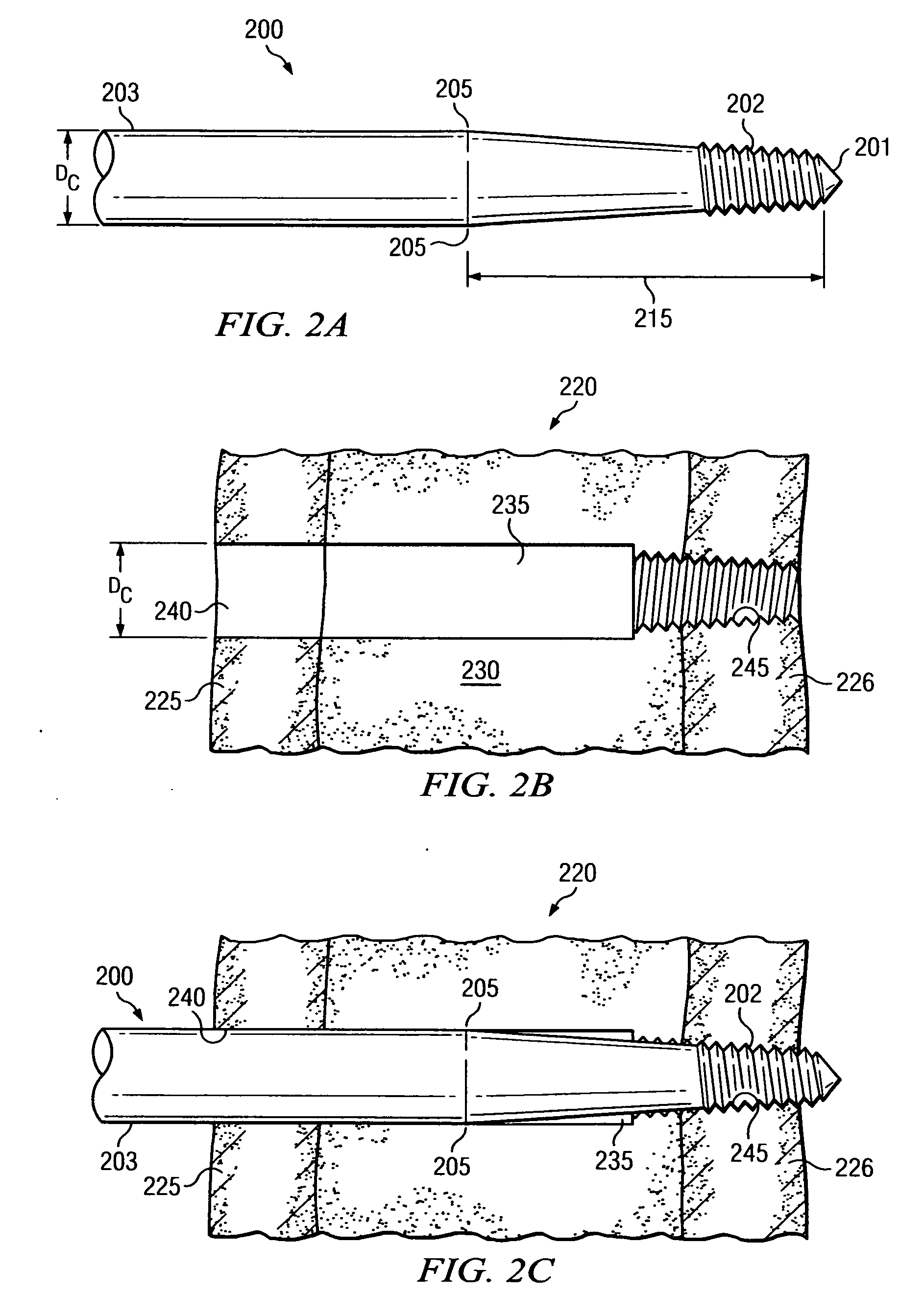 Engaging predetermined radial preloads in securing an orthopedic fastener